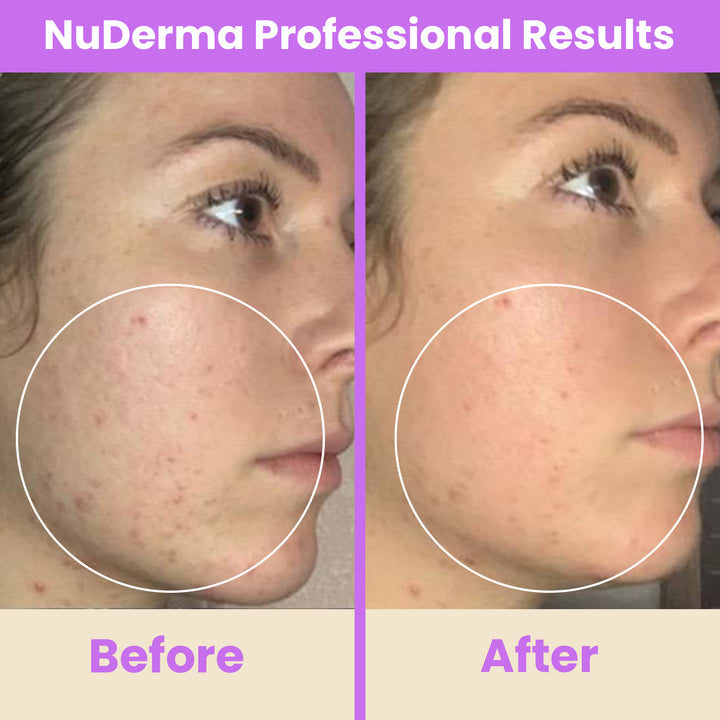 NuDerma Professional High Frequency Wand