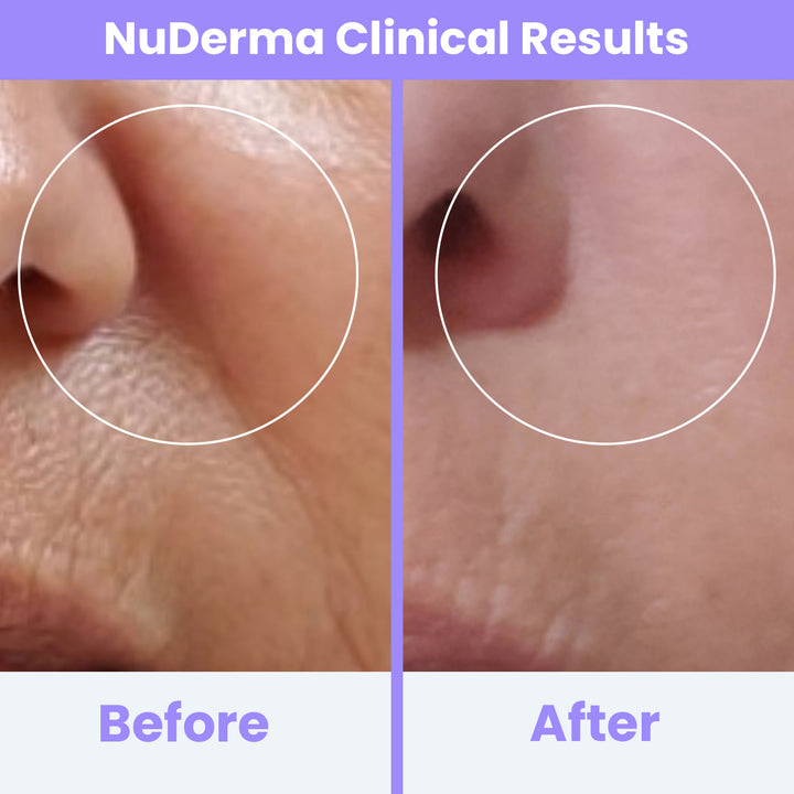 NuDerma Clinical High Frequency Wand