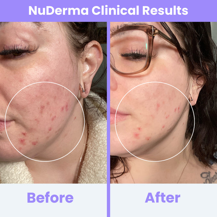 NuDerma Clinical High Frequency Wand