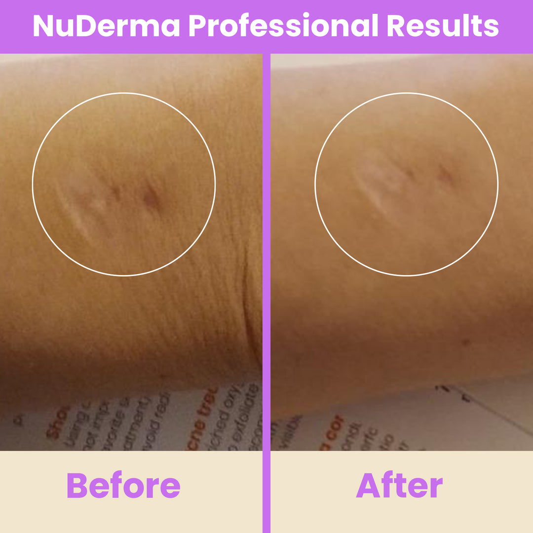 NuDerma Professional High Frequency Wand